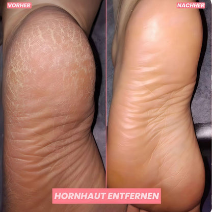 CallusCare™ - Elektrische Hornhautfeile für babyweiche Haut